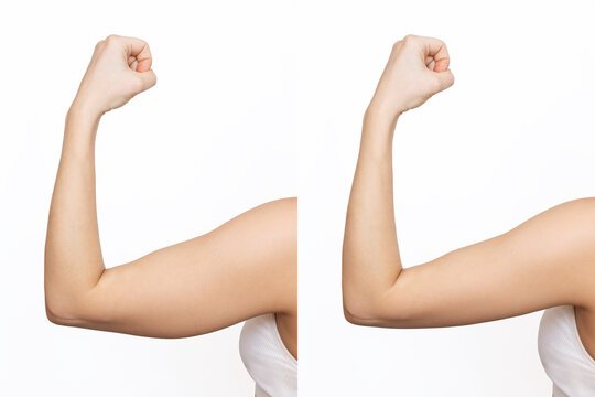 How Arm Lift Surgery in Riyadh Restores Your Natural Contours